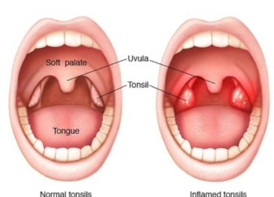 آشنایی با التهاب یا ورم لوزه Tonsillitis به همراه علائم و راه های درمان آن